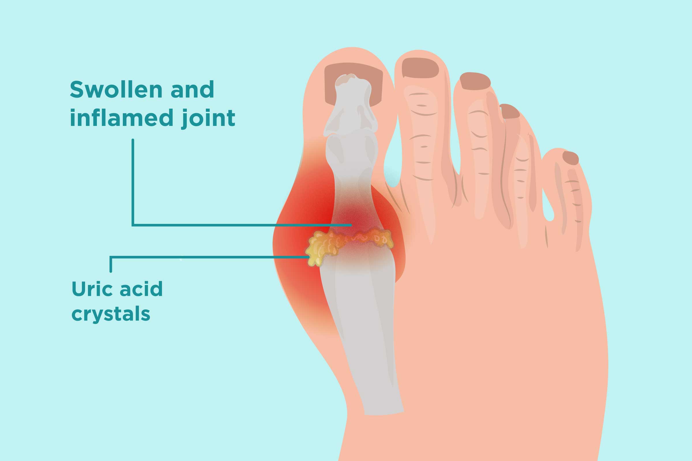 CBD and Gout