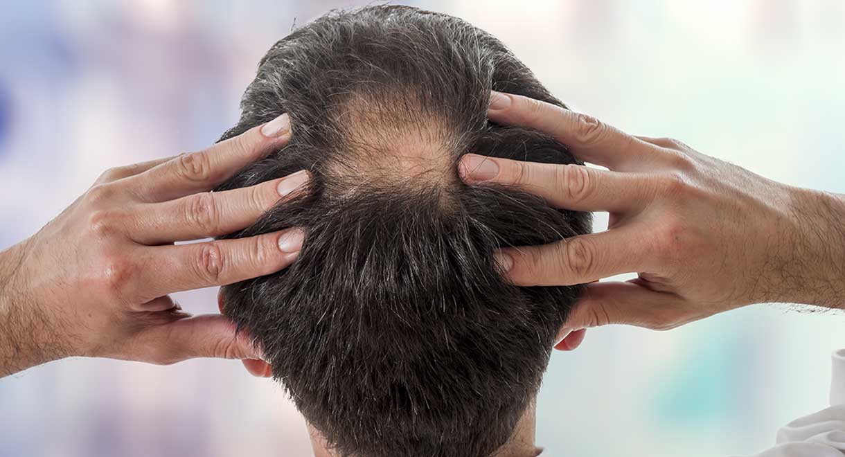 CBD (Cannabidiol) and Hair Loss